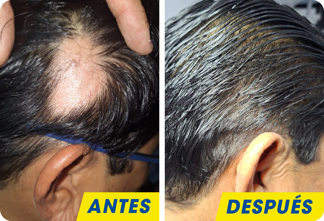 Alopecia