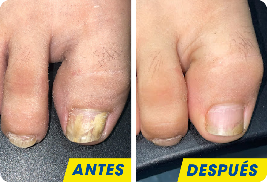Onicomicosis