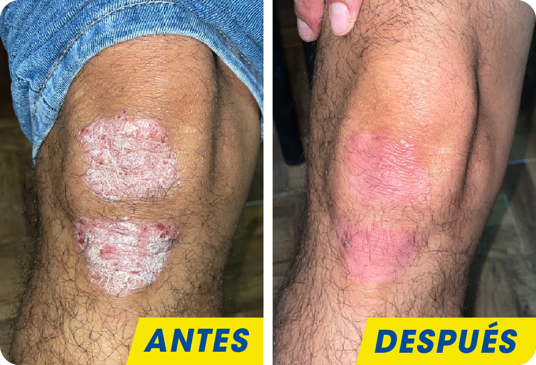 Psoriasis