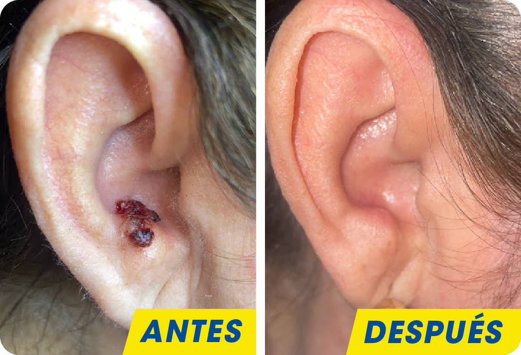 Verruga viral