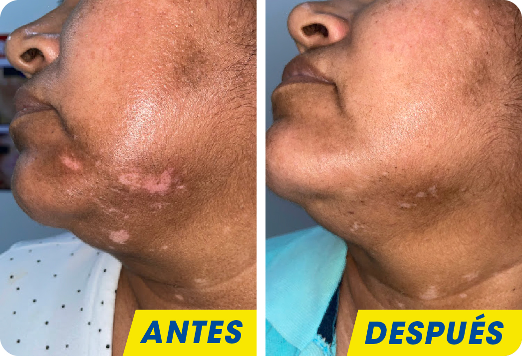 Vitiligo